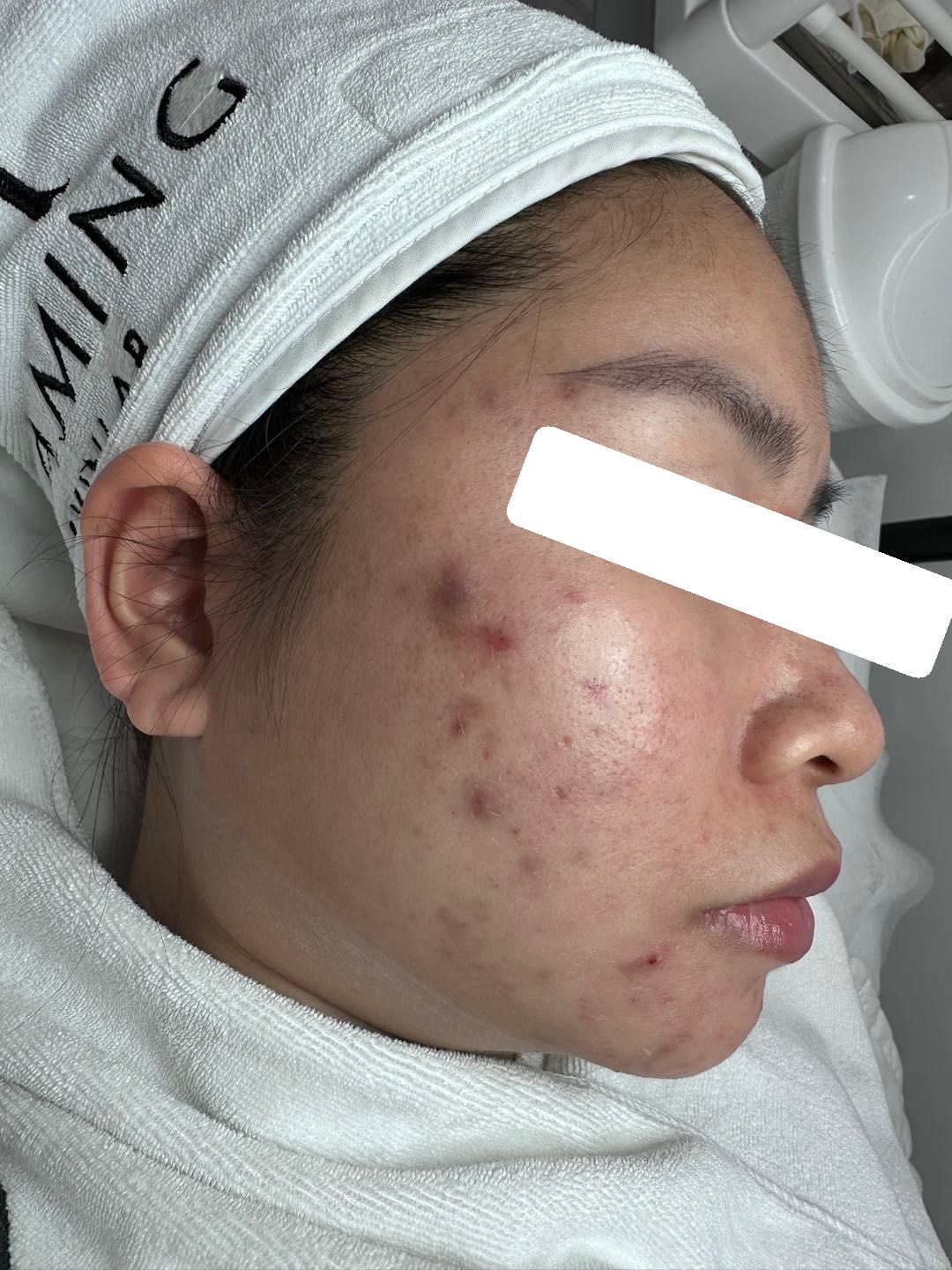 Nhiều ổ viêm, PIH — trước điều trị