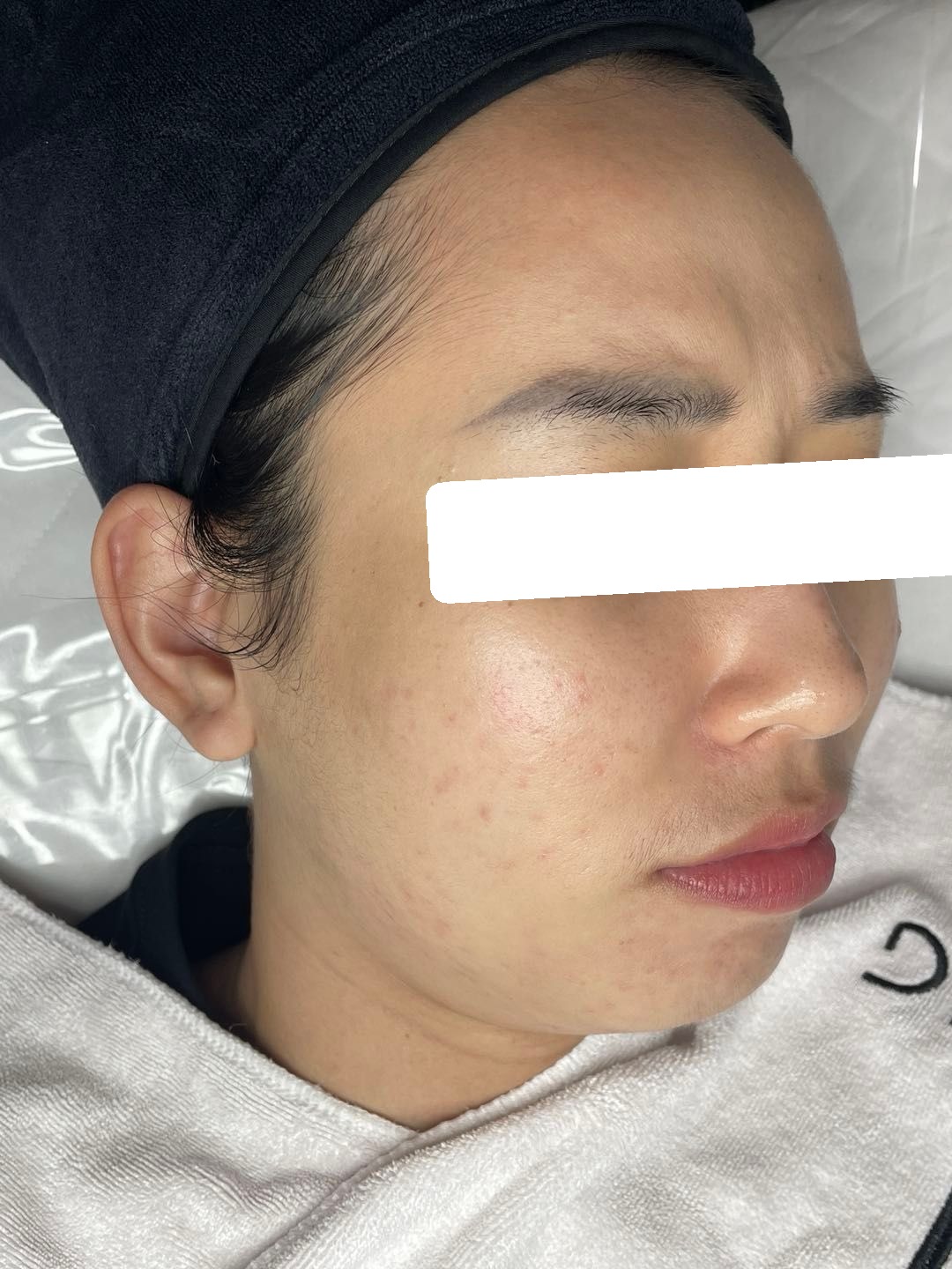 Mụn viêm nội tiết, PIE, sẹo, da đỏ nhạy cảm — sau điều trị