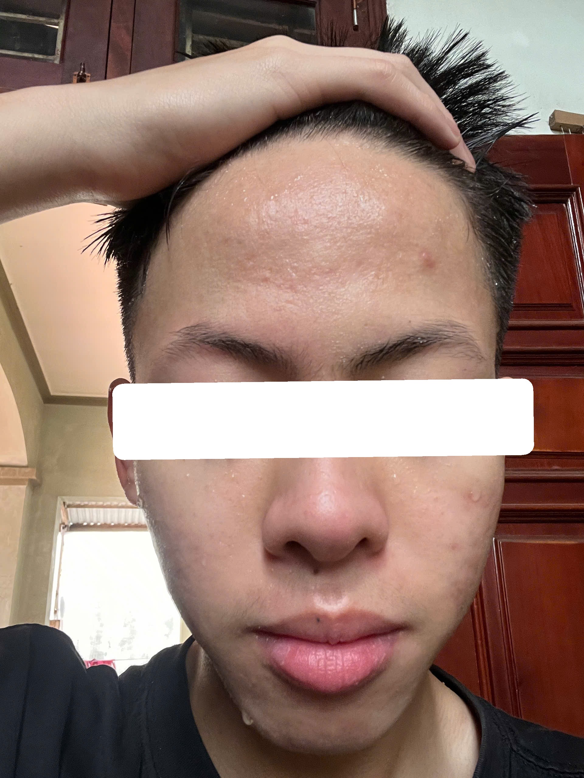 Mụn trứng cá bội nhiễm mức độ nặng — sau điều trị