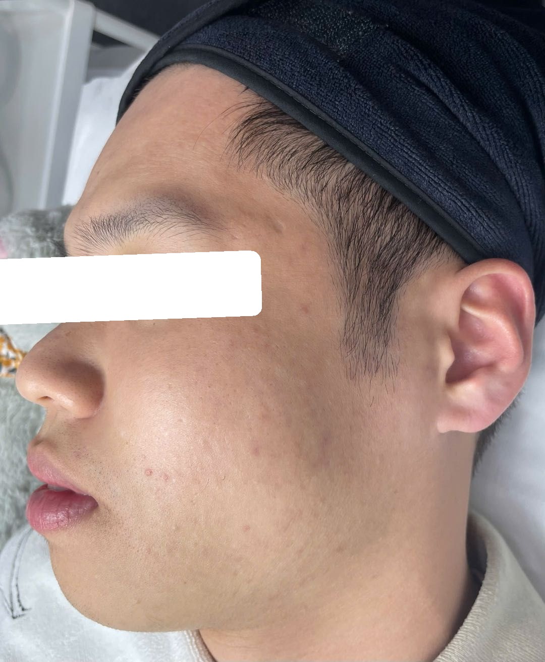 Mụn ẩn, PIH, da dày sừng — sau điều trị