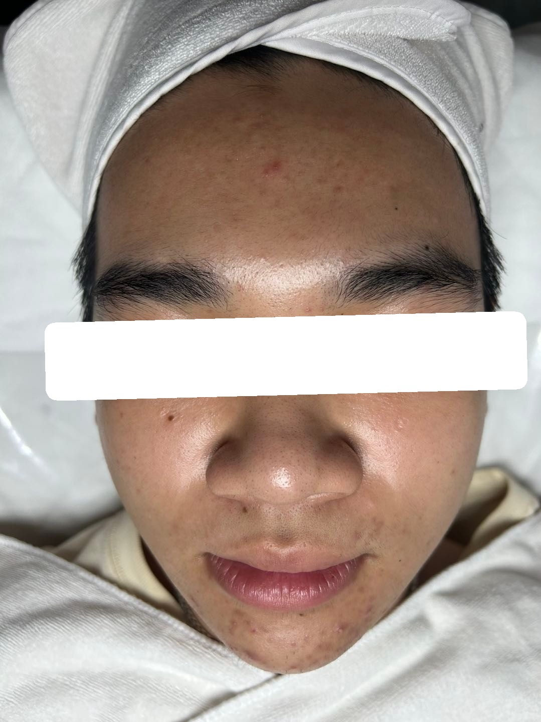 Mụn ẩn, viêm trên nền da dầu dày sừng, PIH, PIE — sau điều trị
