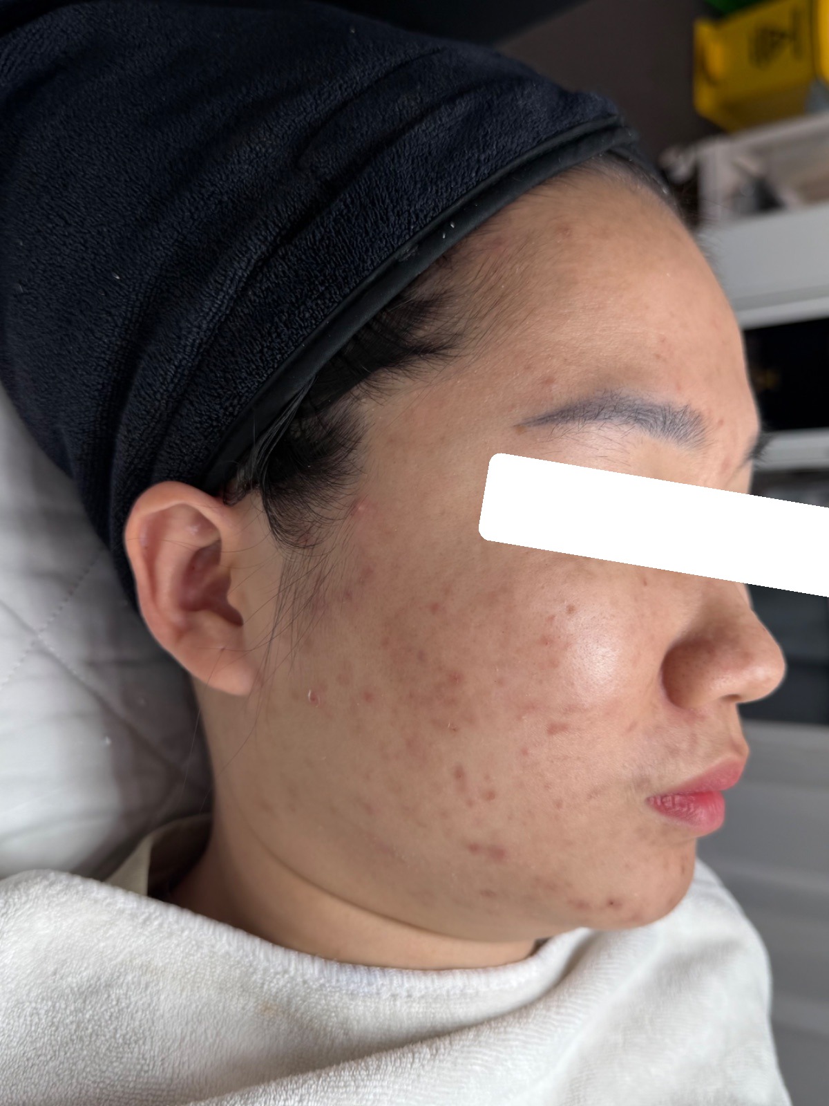 Mụn ẩn bít tắc, PIH — sau điều trị