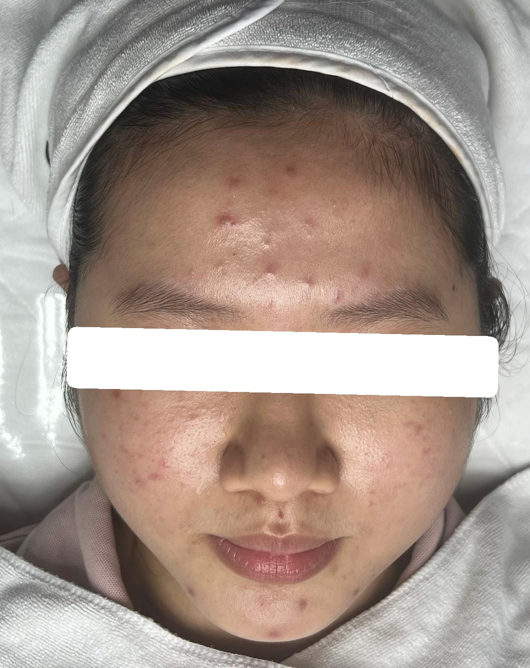 Mụn viêm nội tết, mụn ẩn, PIH — trước điều trị