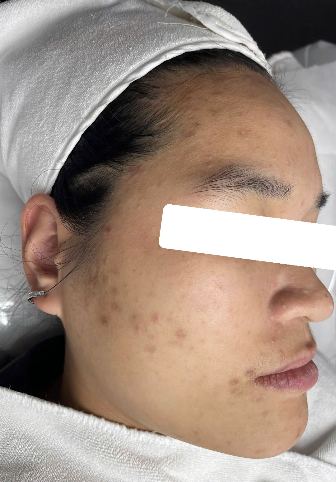 Mụn ẩn, bít tắc, PIH — trước điều trị