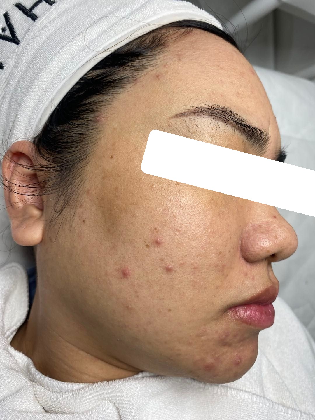 Mụn viêm nội tiết trên nền da dầy sừng, sần vỏ cam, PIH — trước điều trị