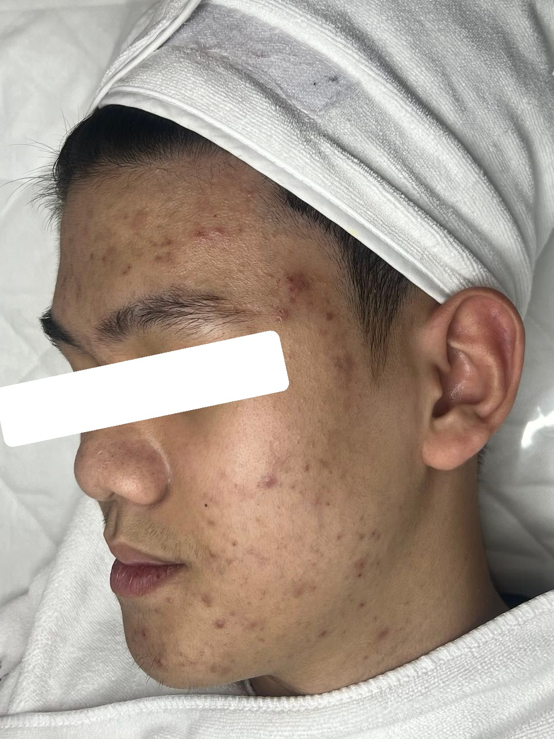 Mụn viêm, ẩn, PIH, sẹo — trước điều trị