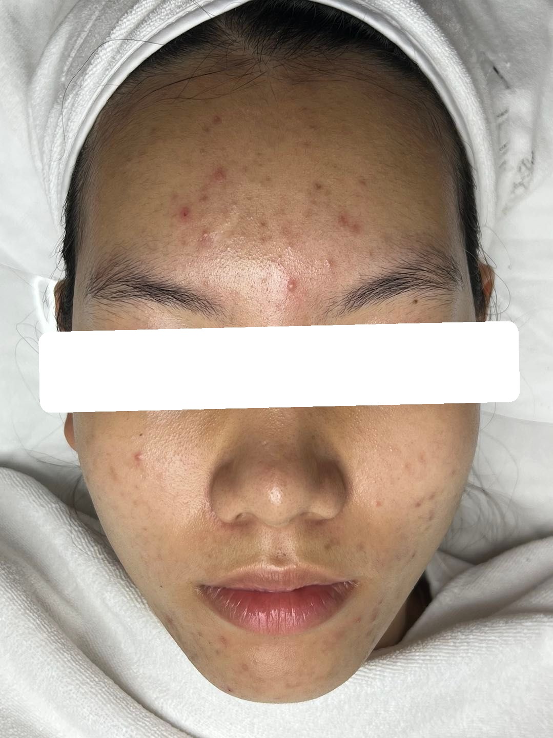 Nhiều mụn ẩn, viêm, PIH — trước điều trị