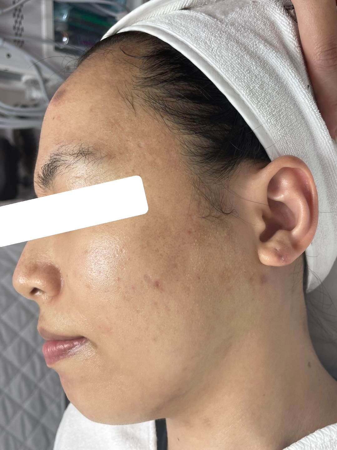 PIH, sẹo — sau điều trị