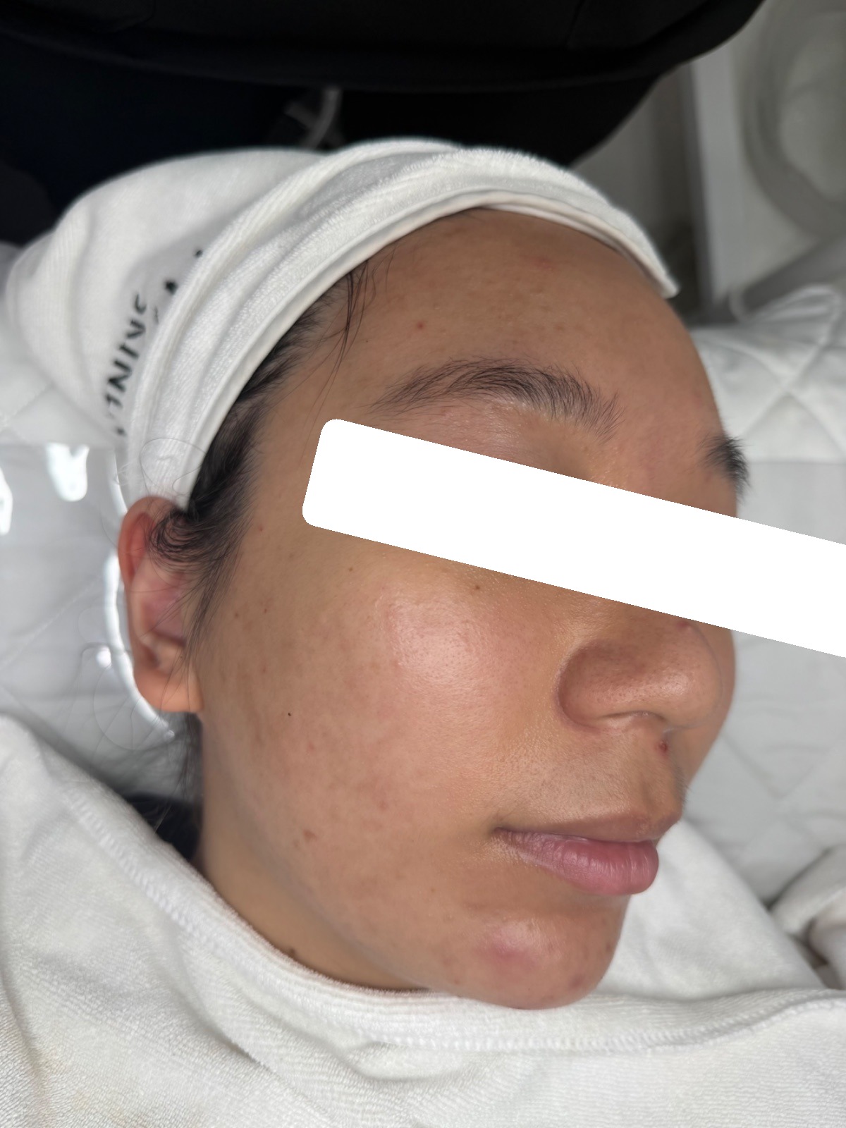 Nhiều mụn ẩn, bít tắc, viêm vùng viền hàm, PIH, da dầu dày sừng — sau điều trị