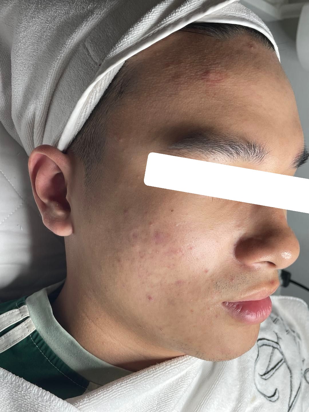 Mụn viêm, mụn ẩn, sẹo, PIE — sau điều trị