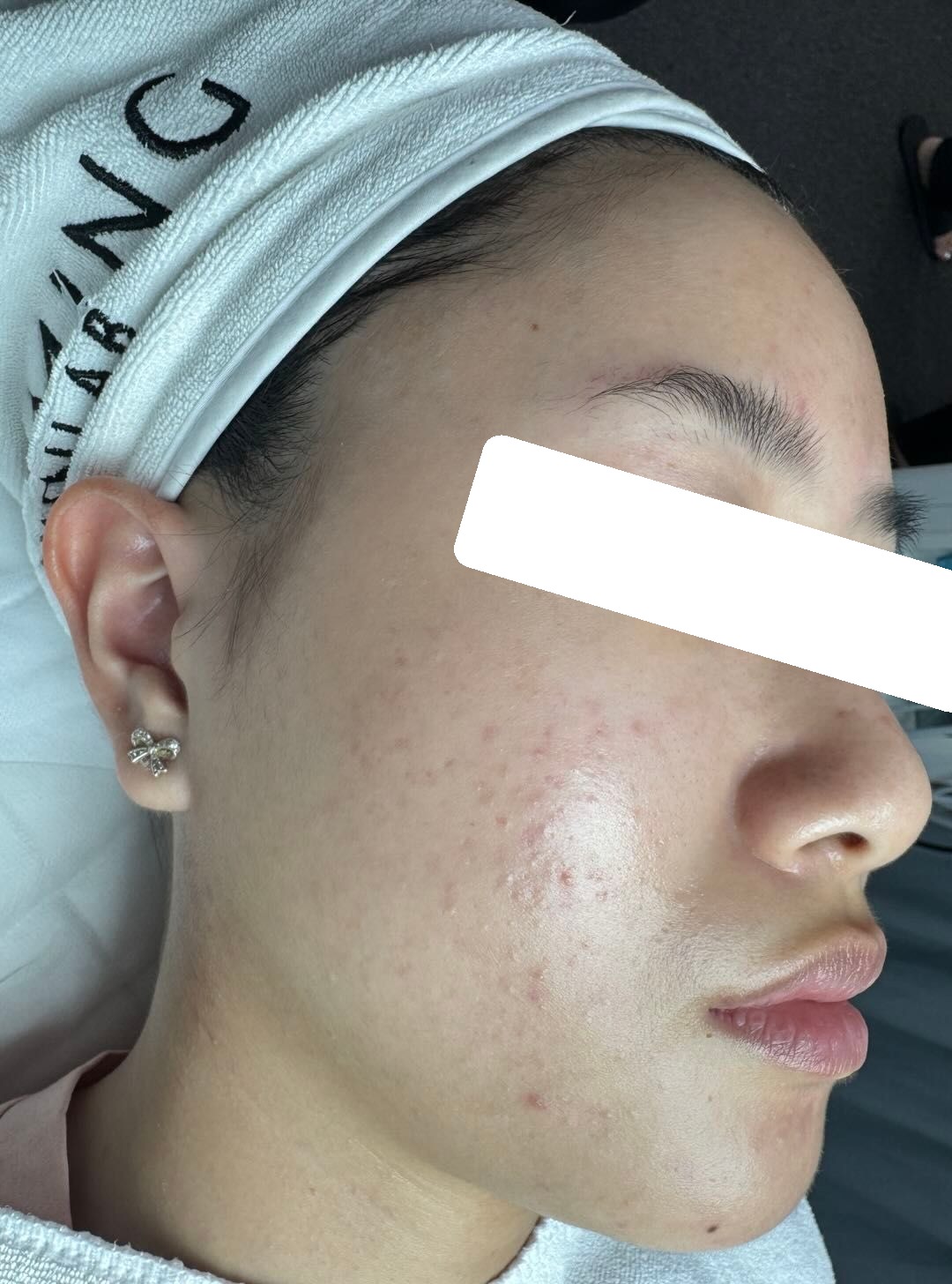 Nhiều mụn ẩn, bít tắc, da dầu dày sừng — sau điều trị