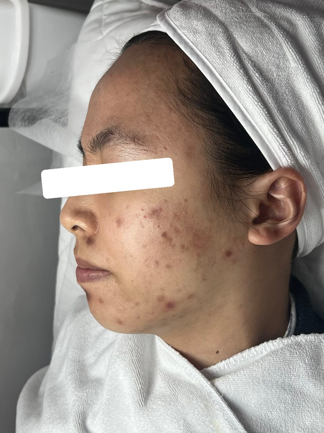 PIH, sẹo — trước điều trị