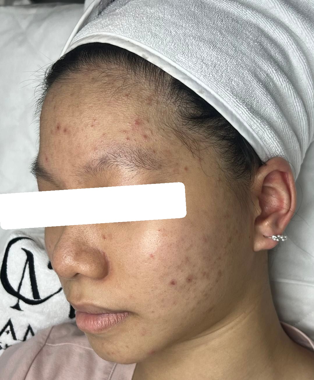 Nhiều mụn ẩn, da dầu dày sừng, PIH — trước điều trị