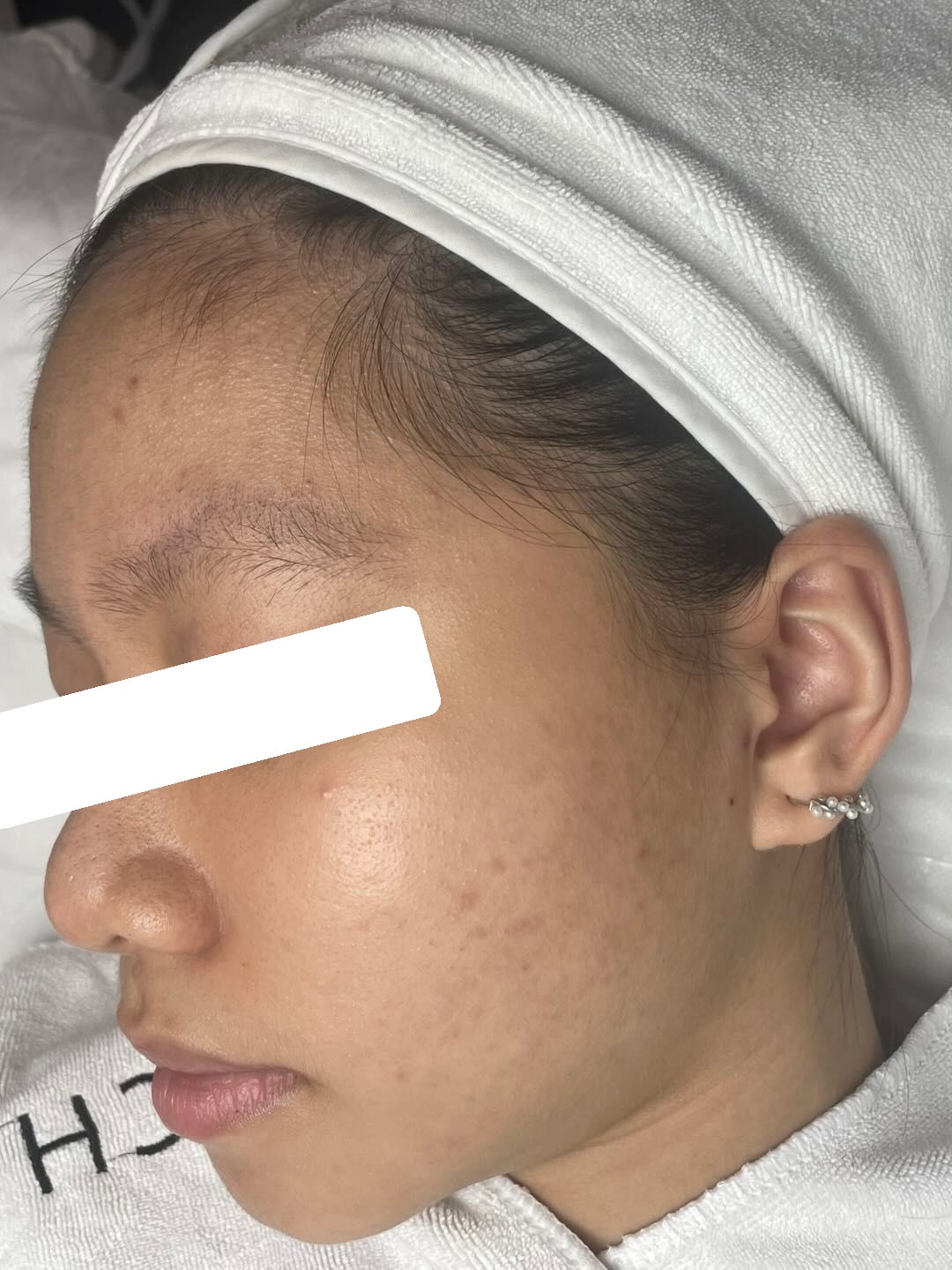 Nhiều mụn ẩn, da dầu dày sừng, PIH — sau điều trị