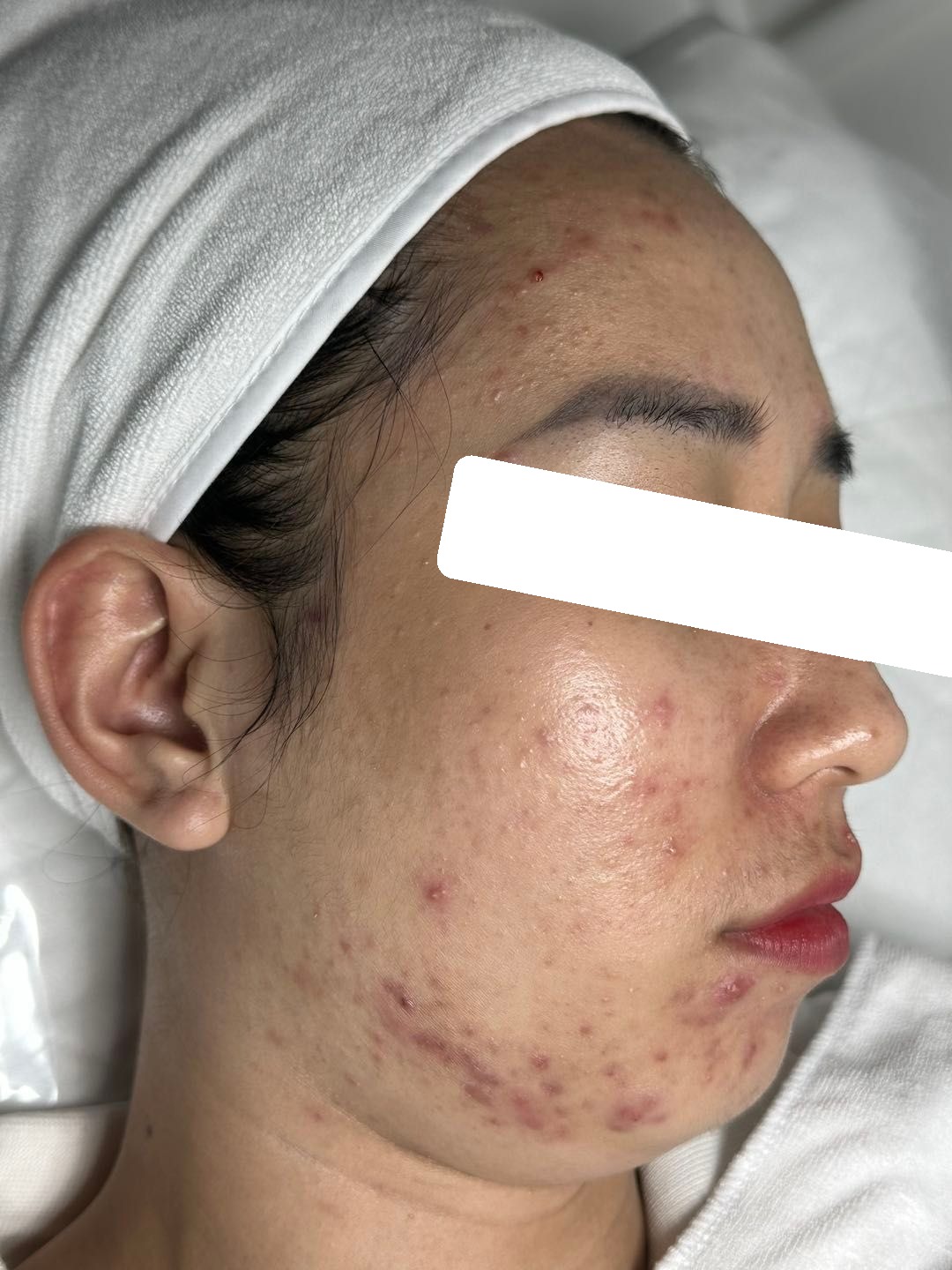 Mụn viêm nội tiết, PIE, sẹo, da đỏ nhạy cảm — trước điều trị