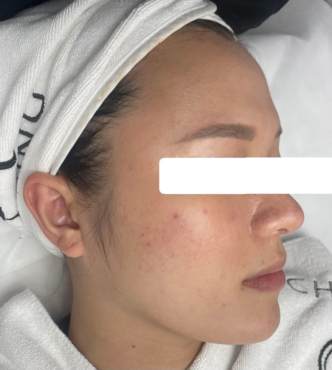 Mụn nấm men,da nhạy cảm mỏng yếu — sau điều trị