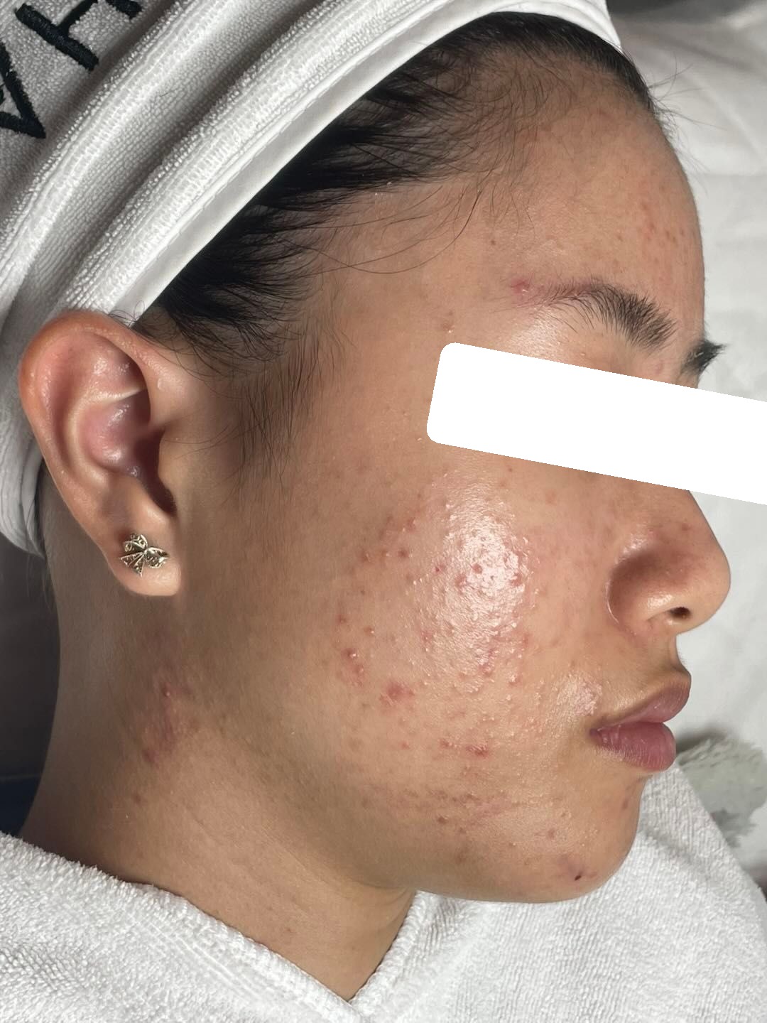 Nhiều mụn ẩn, bít tắc, da dầu dày sừng — trước điều trị