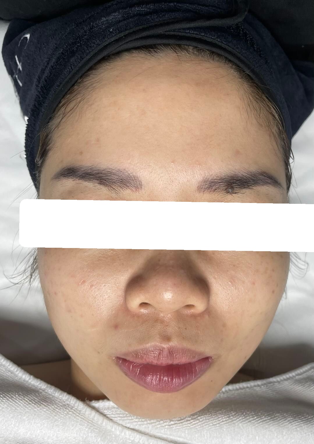 Mụn ẩn, bít tắc, PIH — sau điều trị