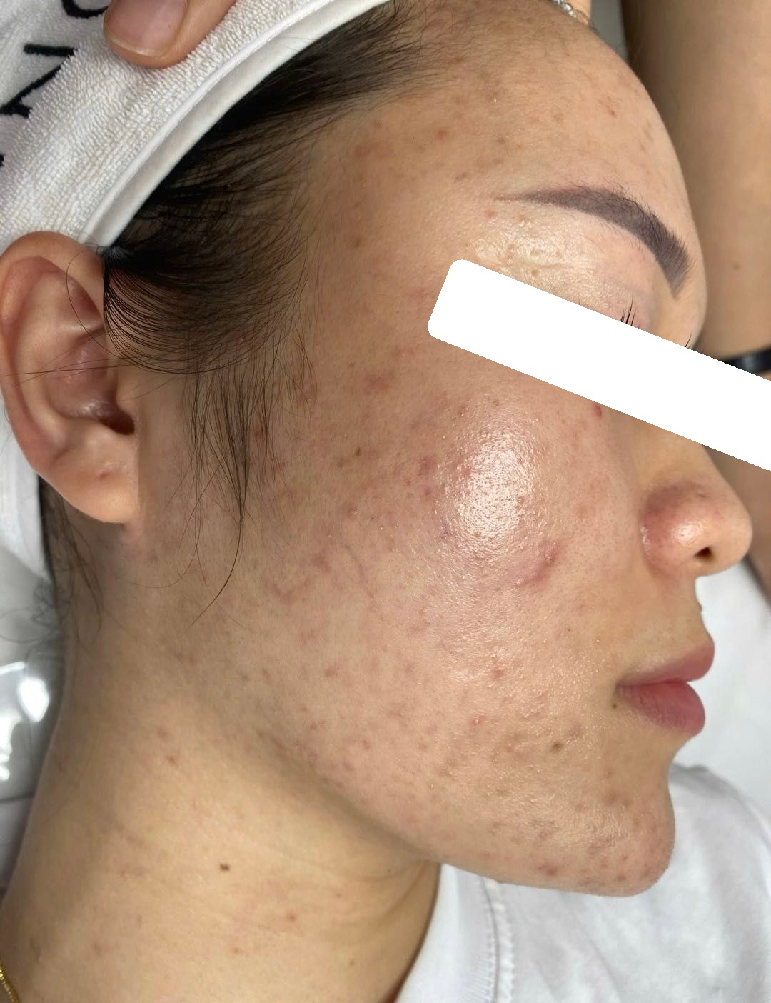 Mụn nấm men,da nhạy cảm mỏng yếu — trước điều trị