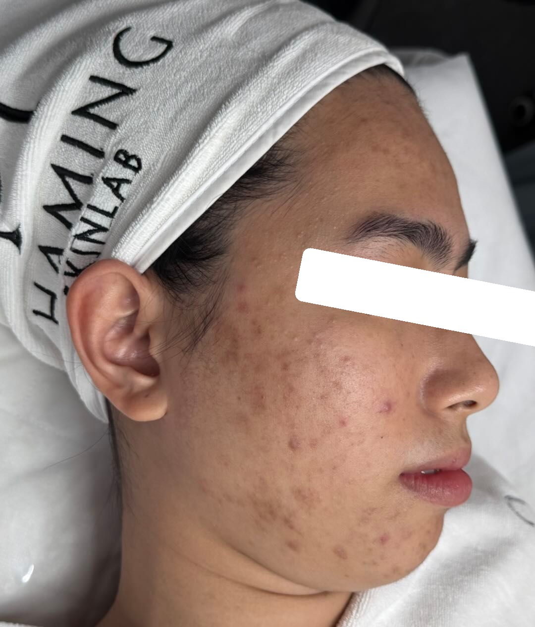 Mụn ẩn, viêm, PIH, da dầu dày sừng — trước điều trị