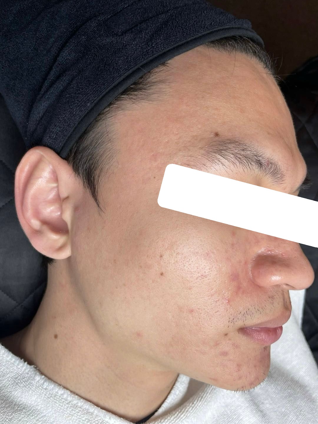 Mụn ẩn, viêm, PIE trên nền da dầu nhạy cảm, đỏ — sau điều trị