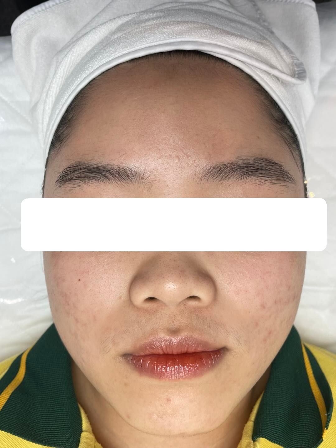 Mụn viêm, ẩn nặng, PIH, da nhiễm rượu thuốc — sau điều trị