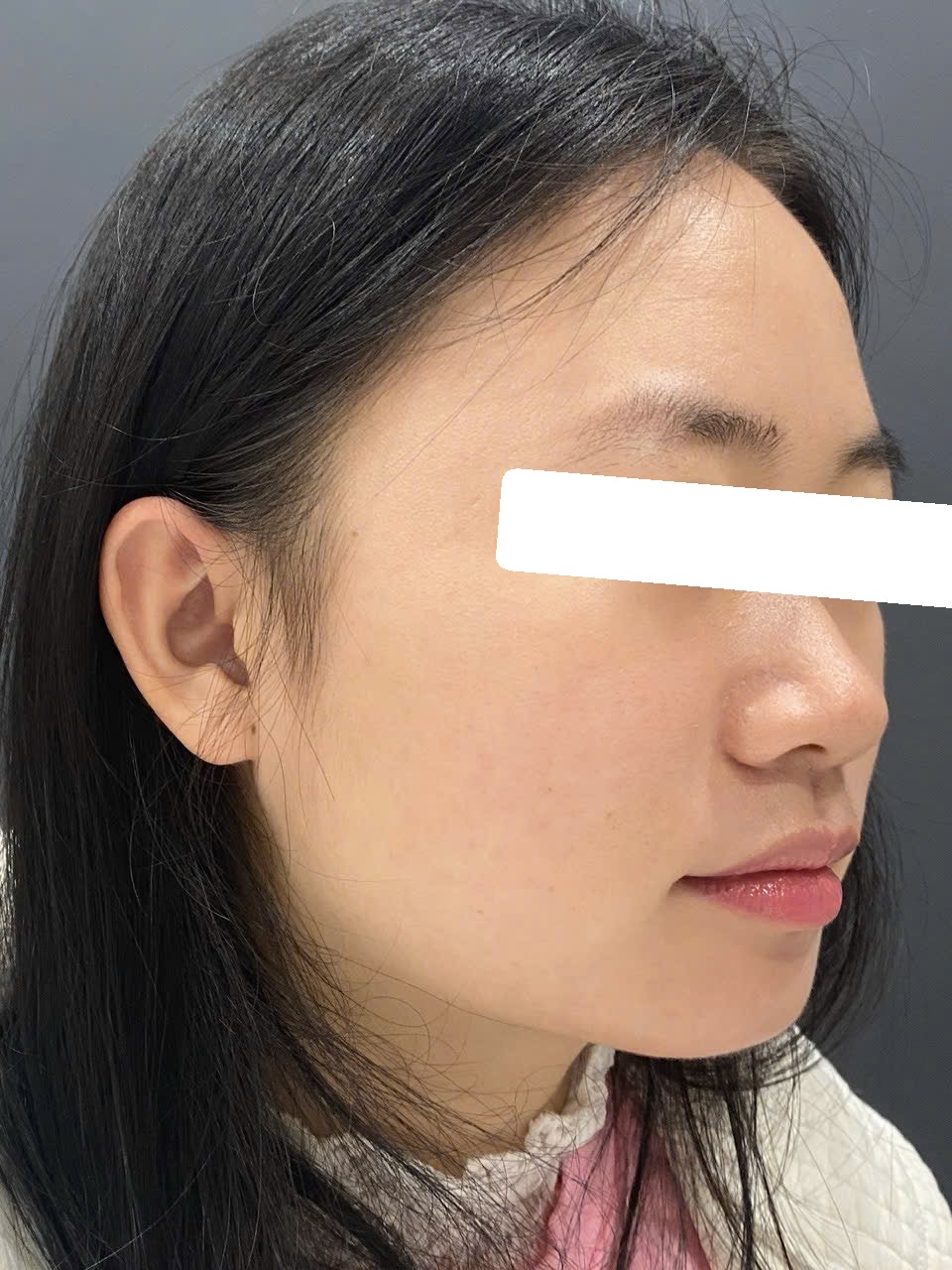 Mụn ẩn trên nền da dầu dày sừng, PIH, PIE — sau điều trị