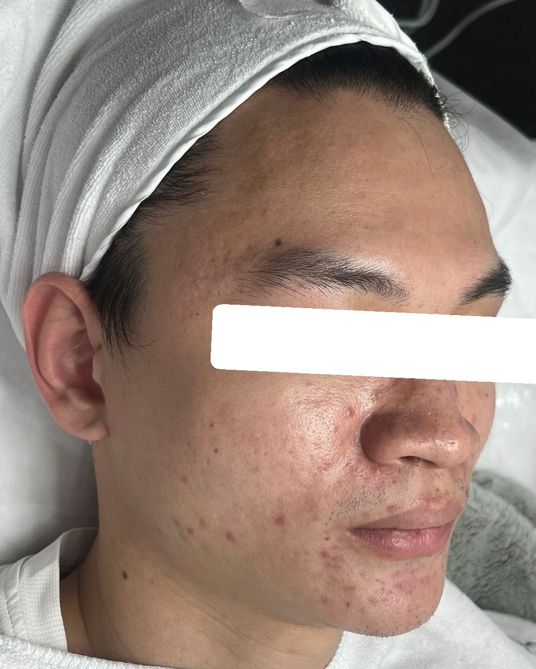 Mụn ẩn, viêm, PIE trên nền da dầu nhạy cảm, đỏ — trước điều trị