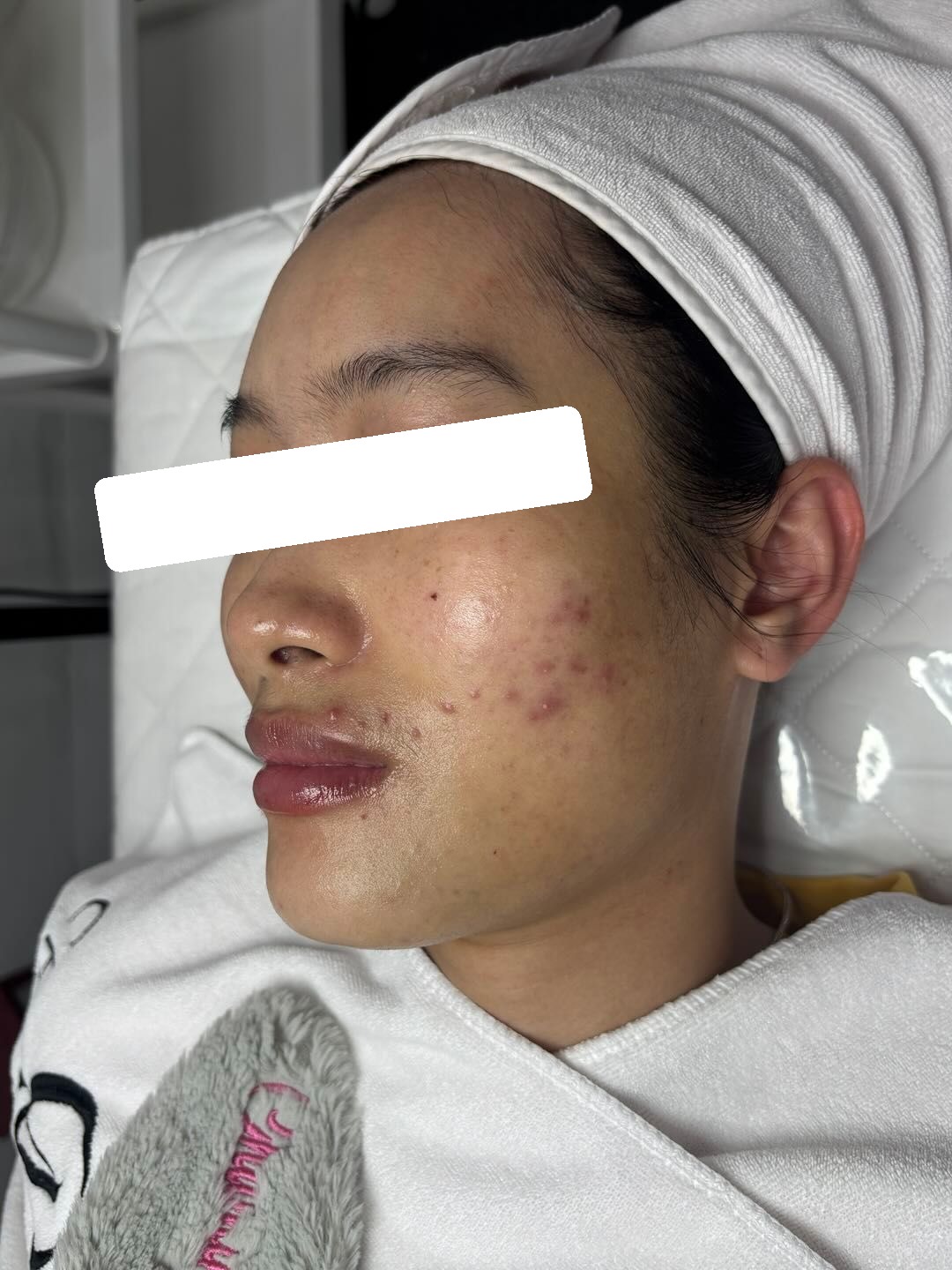 Mụn viêm, mụn ẩn, PIH, da dầu dày sừng — trước điều trị