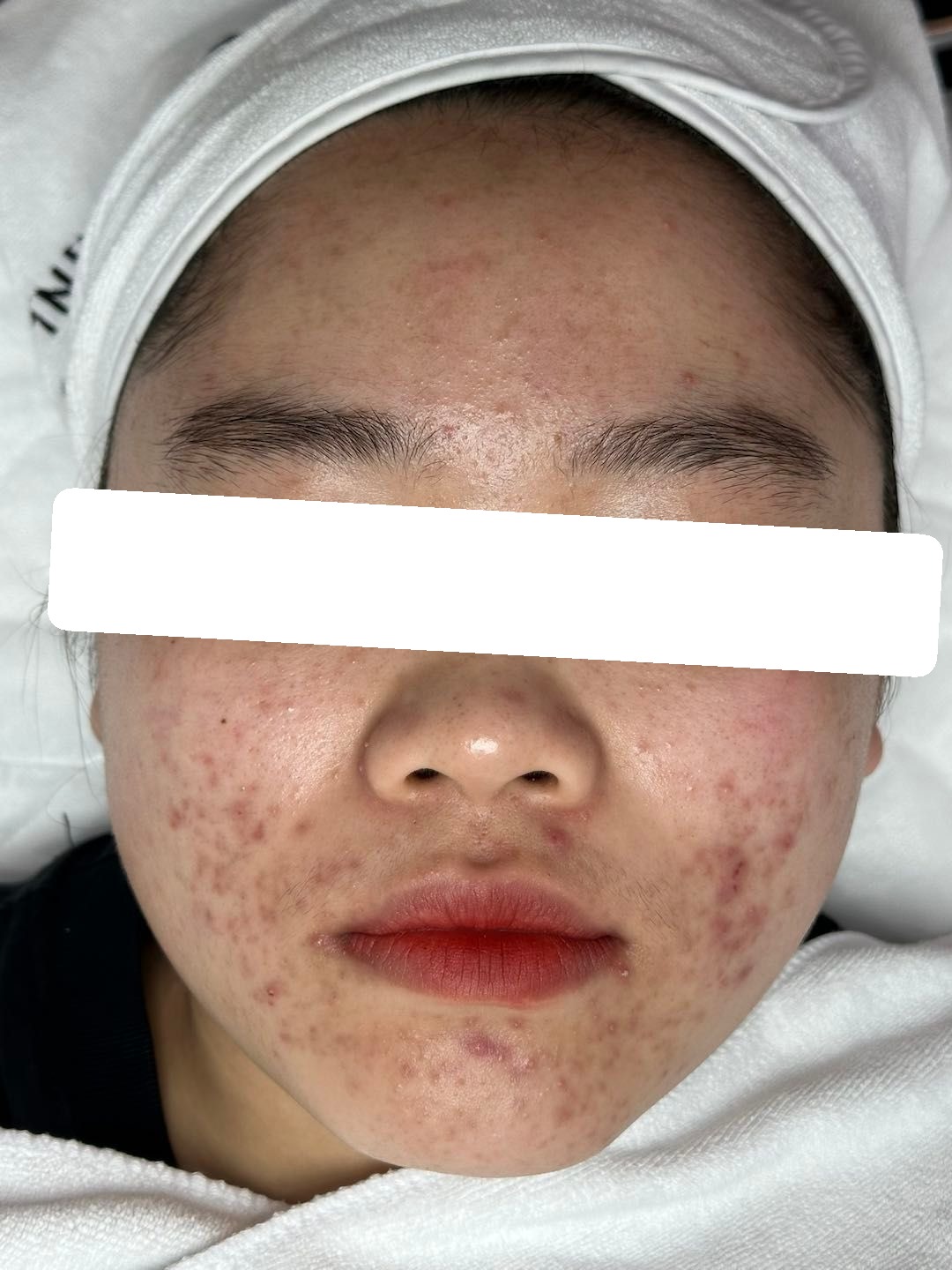 Mụn viêm, ẩn nặng, PIH, da nhiễm rượu thuốc — trước điều trị