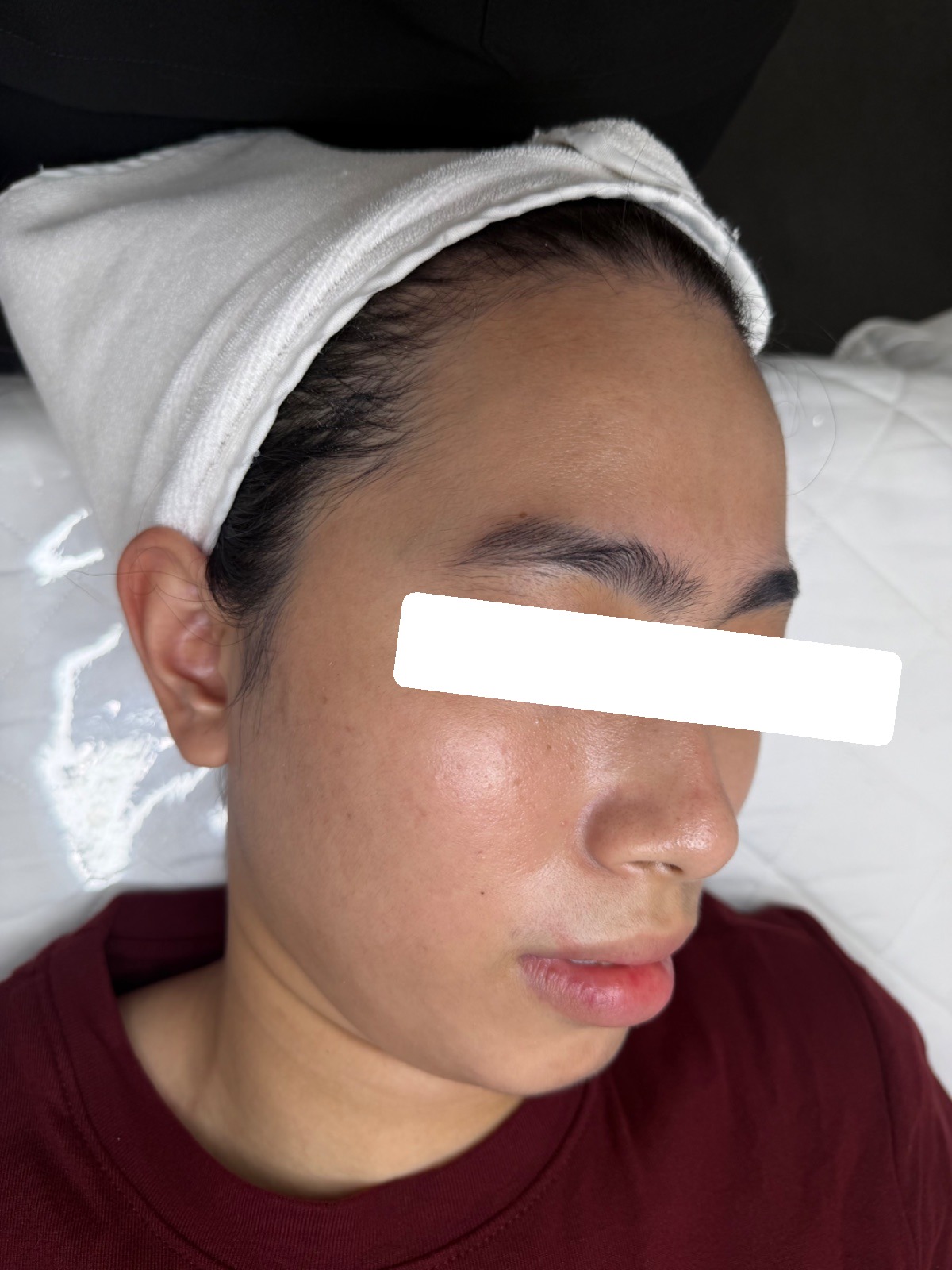 Mụn ẩn, viêm, PIH, da dầu dày sừng — sau điều trị