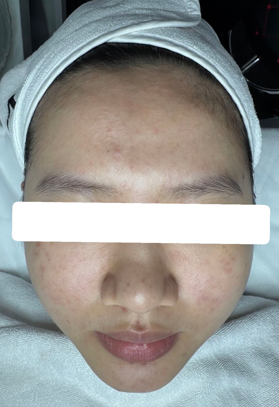 Mụn viêm nội tết, mụn ẩn, PIH — sau điều trị