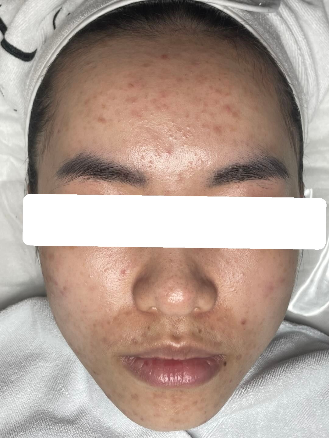 Nhiều mụn ẩn, bít tắc, PIH trên nền da dầu dày sừng — trước điều trị