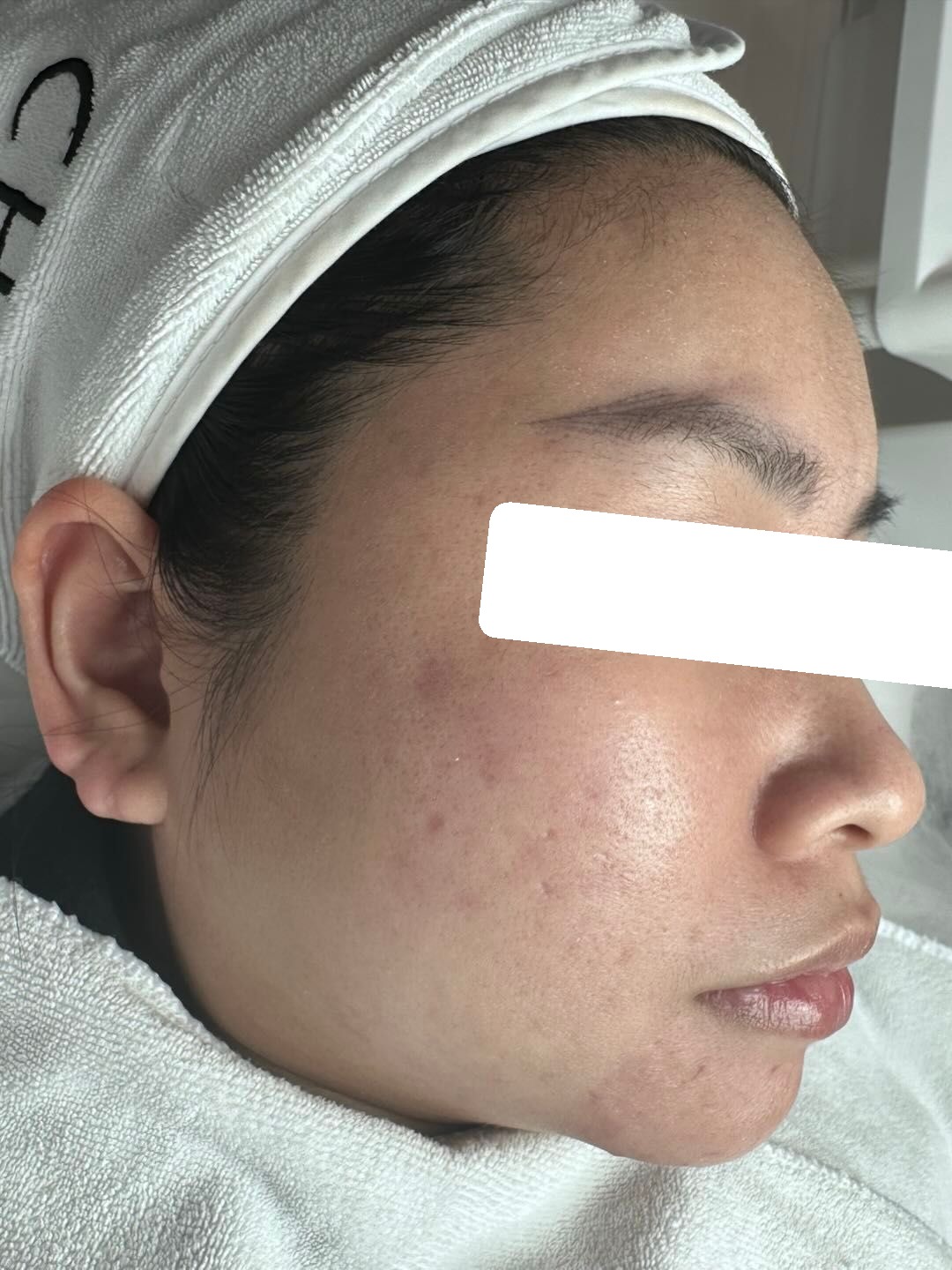 Nhiều ổ viêm, PIH — sau điều trị