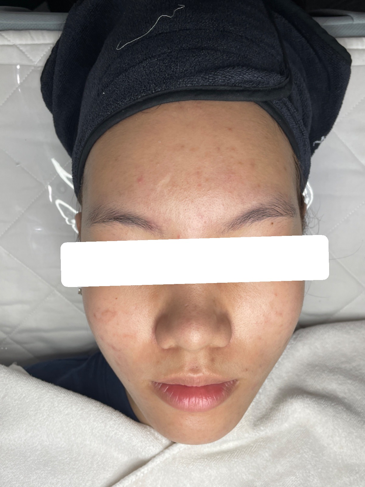 Nhiều mụn ẩn, viêm, PIH — sau điều trị