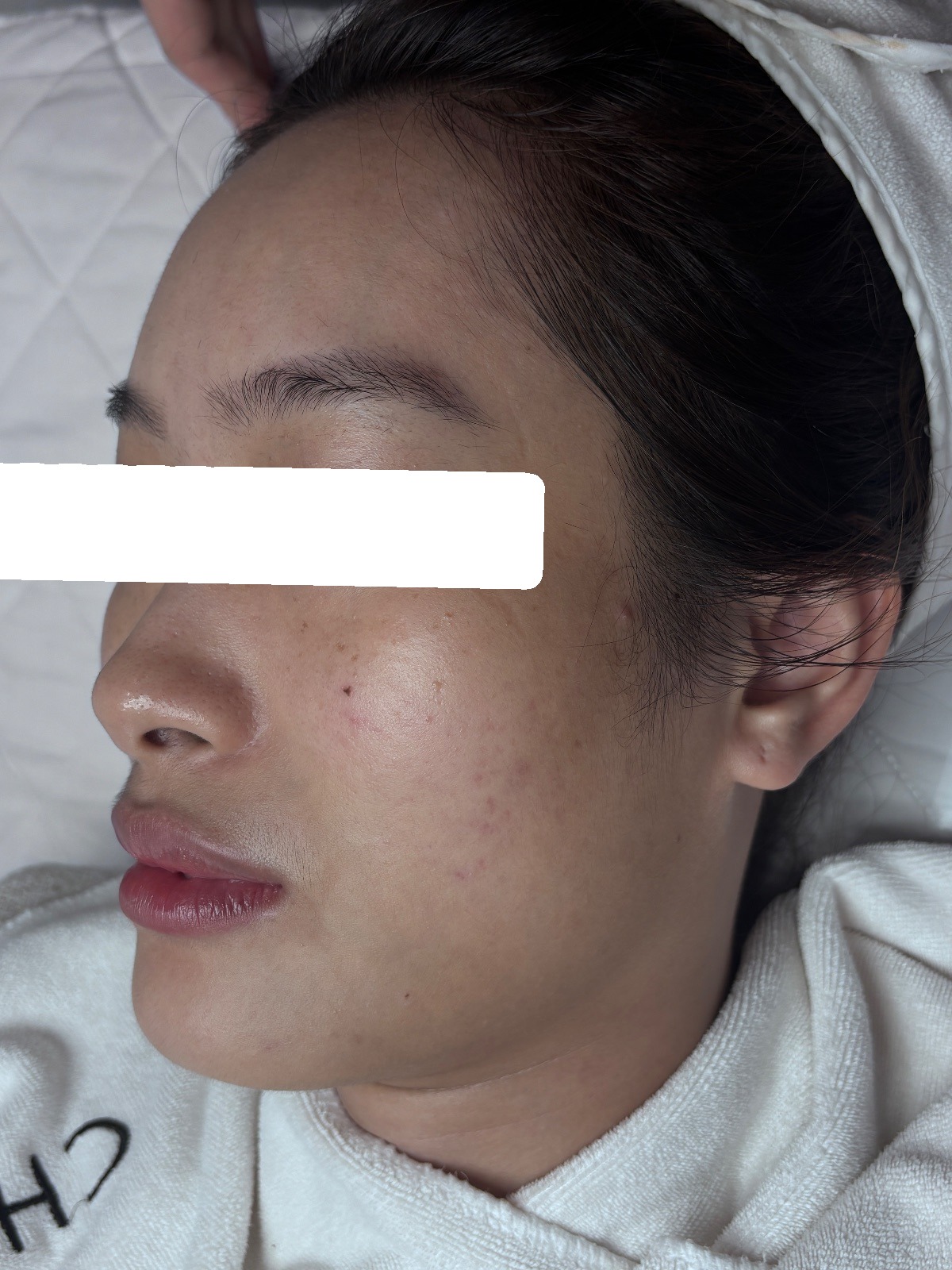 Mụn viêm, mụn ẩn, PIH, da dầu dày sừng — sau điều trị