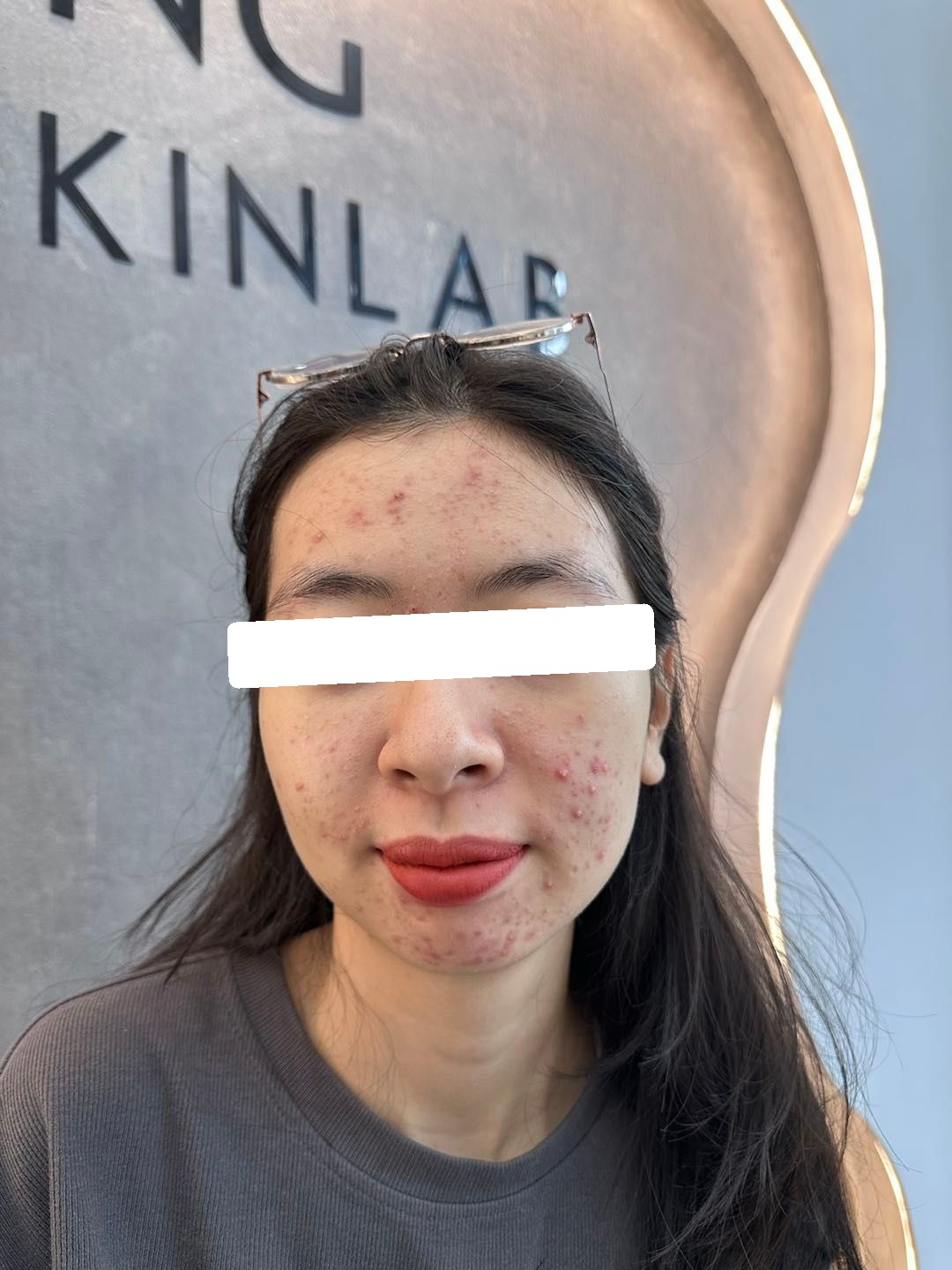 Mụn trứng cá mức độ nặng, PIIE, sẹo — trước điều trị