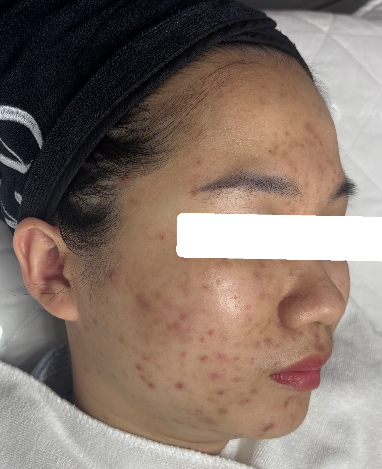 Mụn ẩn bít tắc, PIH — trước điều trị