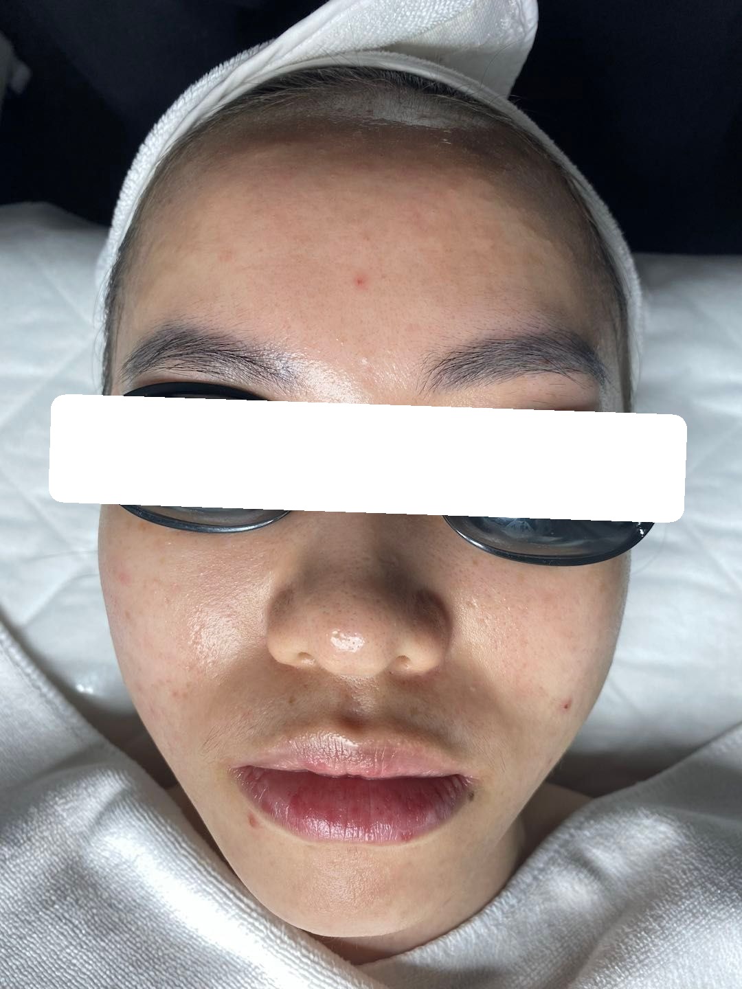 Nhiều mụn ẩn, bít tắc, PIH trên nền da dầu dày sừng — sau điều trị