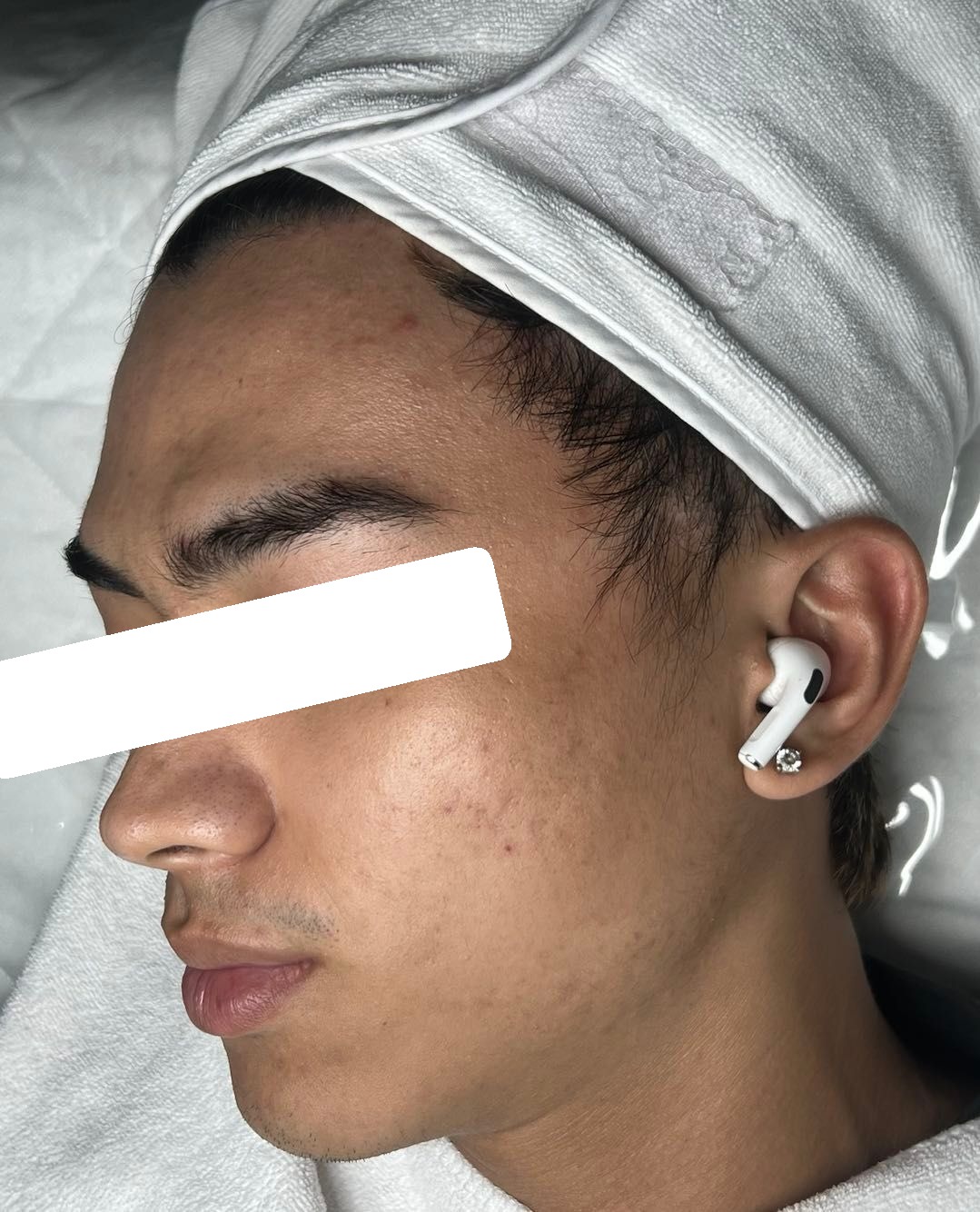 Mụn viêm, ẩn nặng, PIH, sẹo — sau điều trị
