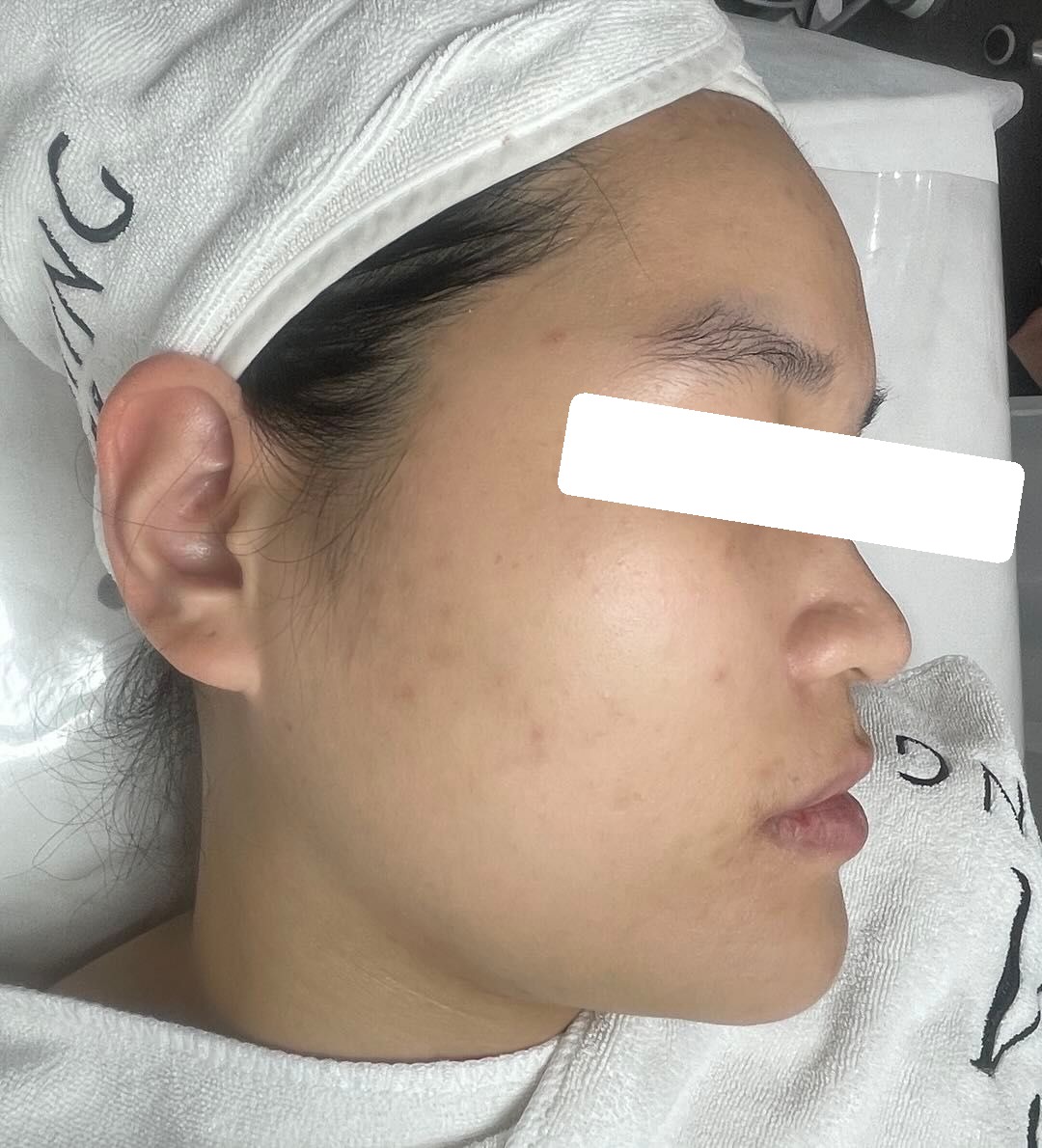 Mụn ẩn, bít tắc, PIH — sau điều trị
