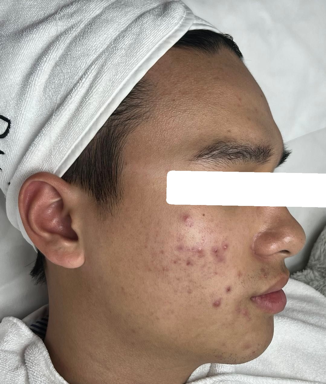Mụn viêm, mụn ẩn, sẹo, PIE — trước điều trị