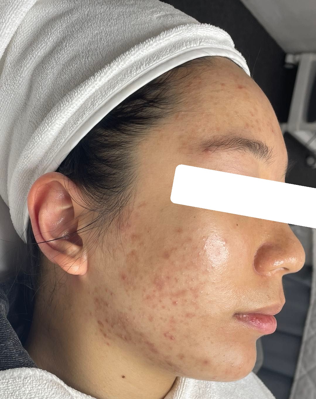 Nhiều mụn ẩn, bít tắc, viêm vùng viền hàm, PIH, da dầu dày sừng — trước điều trị