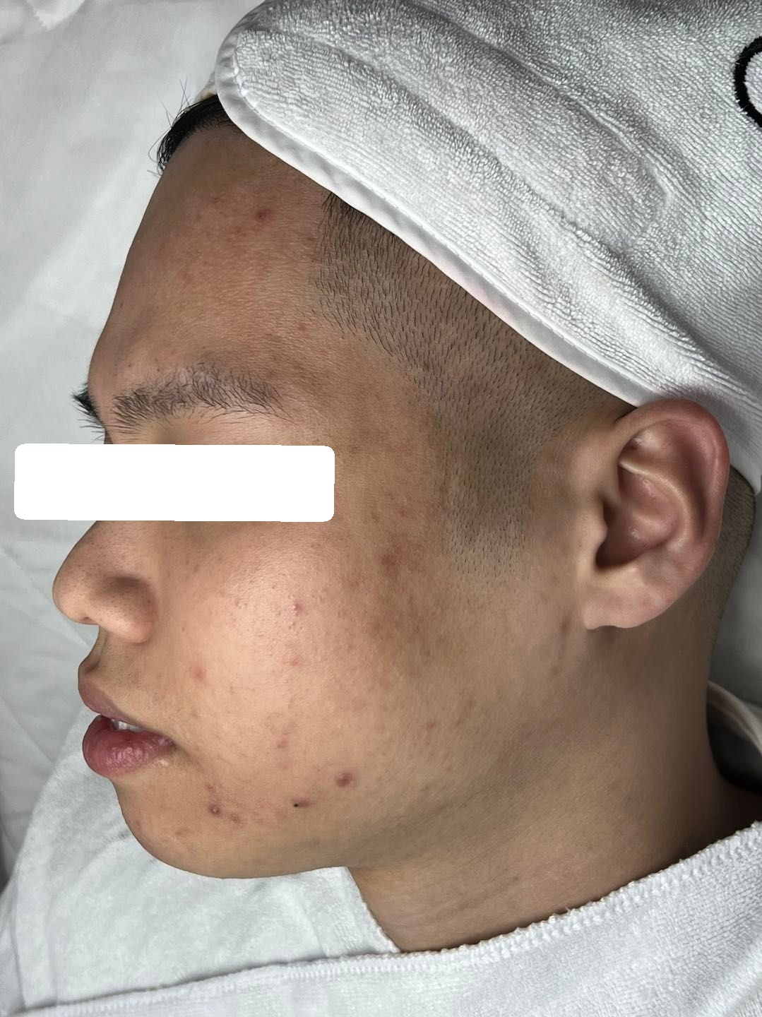 Mụn ẩn, PIH, da dày sừng — trước điều trị