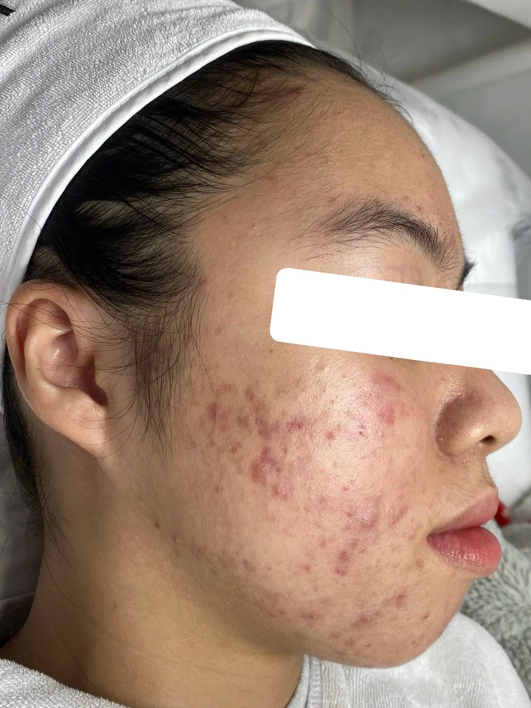 Mụn trứng cá mức độ nặng, PIE, sẹo, nền da nhạy cảm đỏ — trước điều trị
