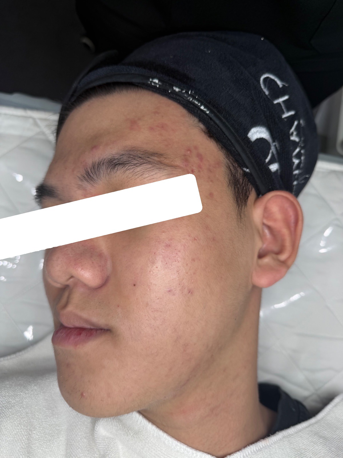 Mụn viêm, ẩn, PIH, sẹo — sau điều trị