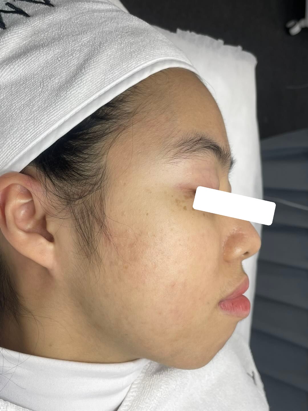 Mụn trứng cá mức độ nặng, PIE, sẹo, nền da nhạy cảm đỏ — sau điều trị