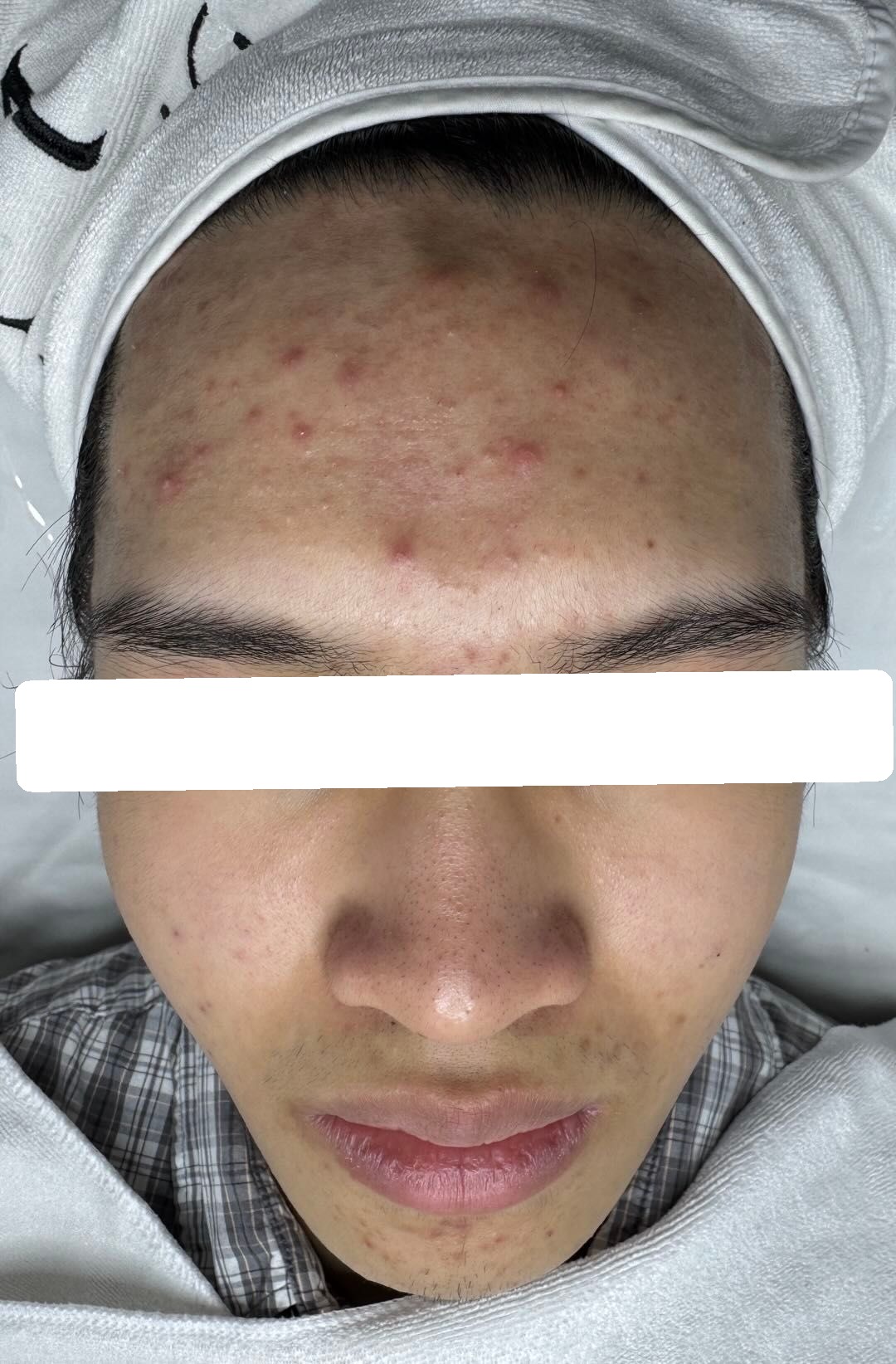 Mụn ẩn, viêm tập trung nhiều vùng trá, dày sừng, PIH — trước điều trị