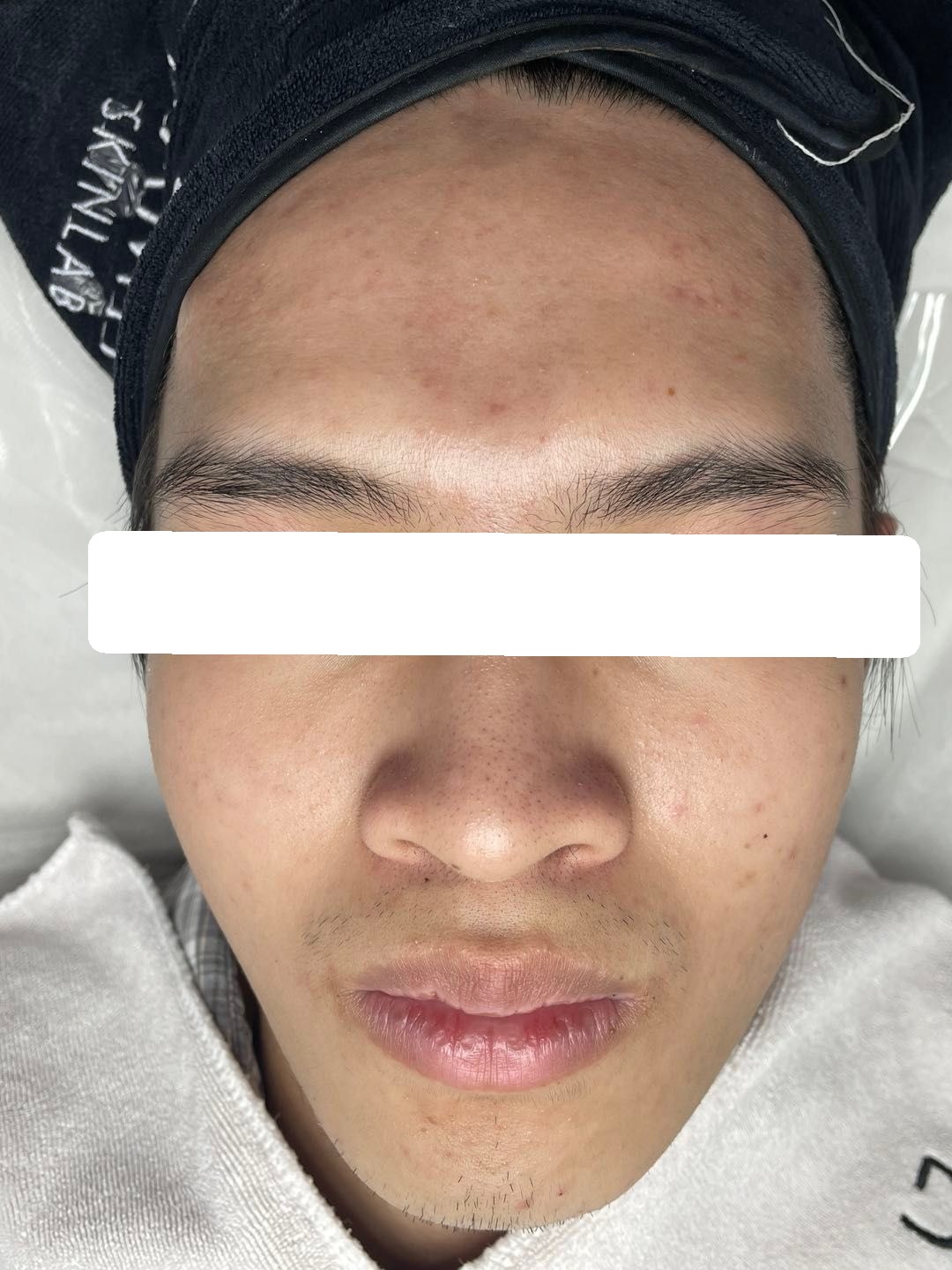 Mụn ẩn, viêm tập trung nhiều vùng trá, dày sừng, PIH — sau điều trị
