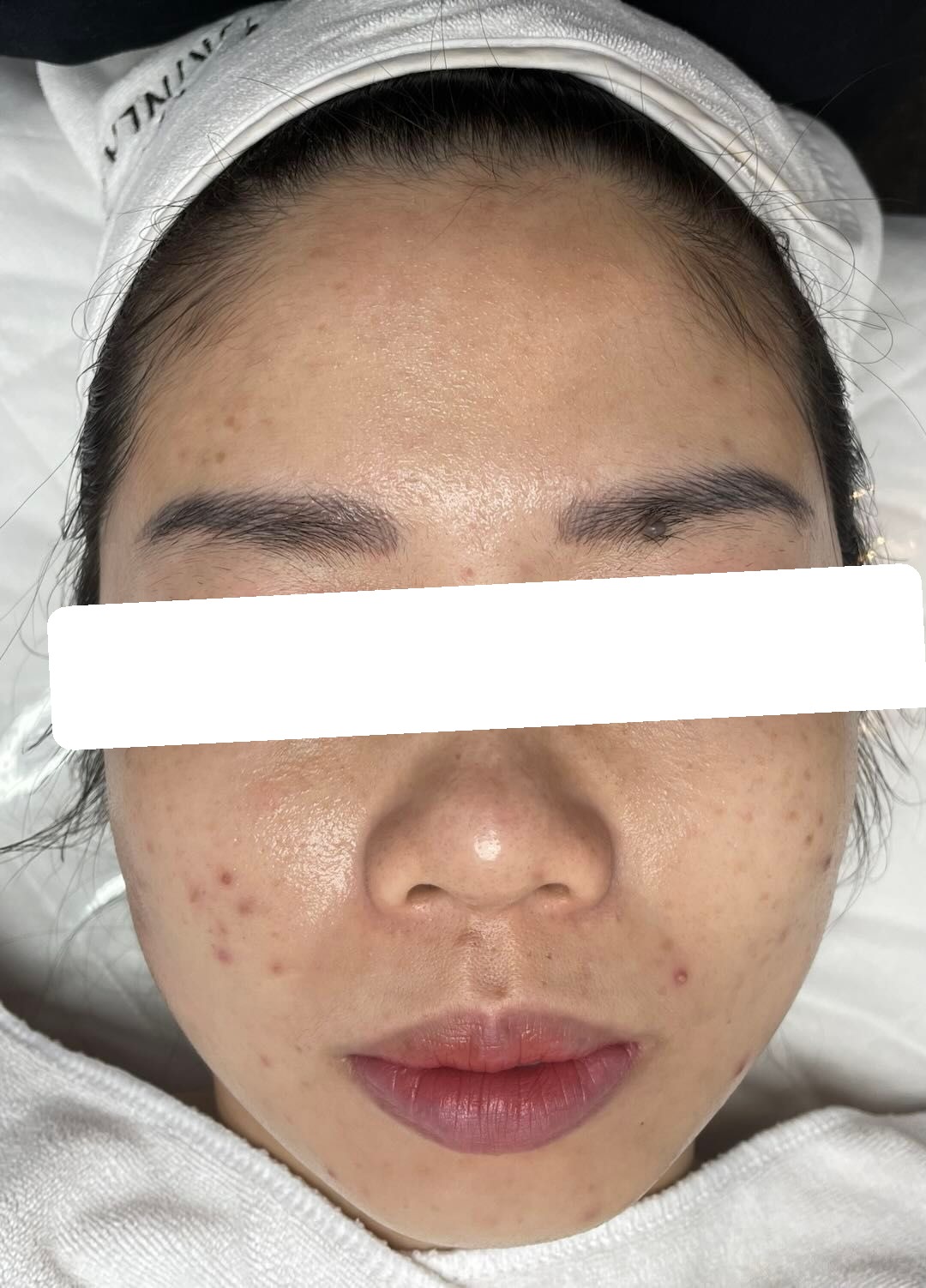 Mụn ẩn, bít tắc, PIH — trước điều trị